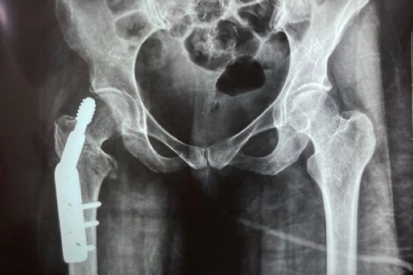 justica-condena-medico-e-hospital-do-parana-por-erro-em-cirurgia-de-fratura-no-femur